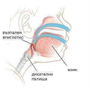 epigloitit